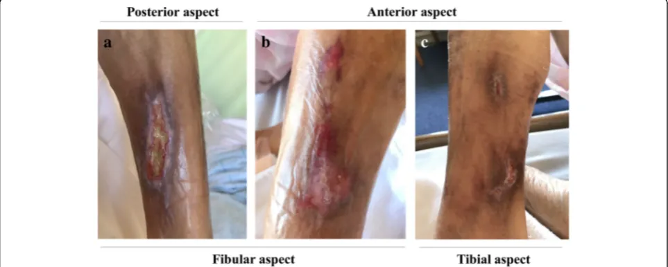 Fig. 1 Gross appearance of the cutaneous ulcers on the patient’s right lower legs at admission