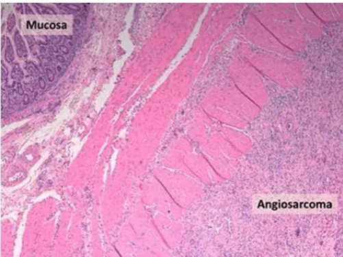 Figure 2: Laparotomy findings: small bowel obstructive tumor. A segmental enterectomy was performed.