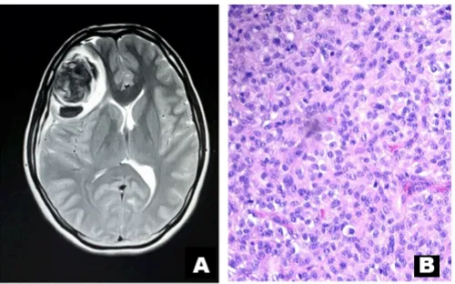 Figure 1: Diffused astrocytoma grade 2. (A) An axial cut of MRI brain with gadolinium contrast, revealed a large cortical based tumor 5.0x4.1x3.7 cm demonstrated in the right frontal lobe with a large area of possibility of intratumoral hemorrhage/calcific