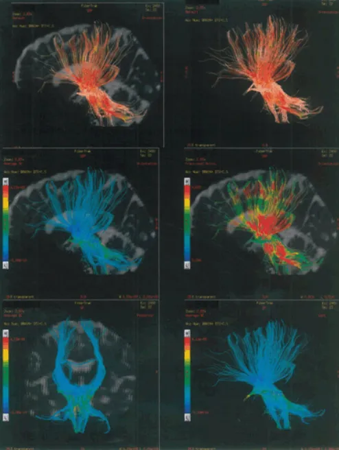 Figure 2:  Tractography of brain showing improvement.