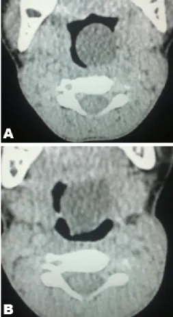 Figure 1 (A, B): A left vallecular cyst on axial views.