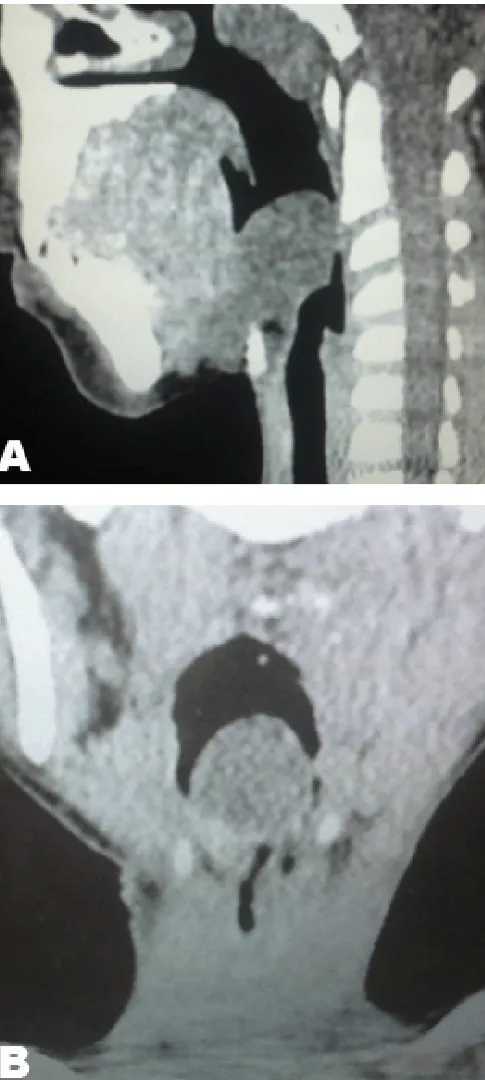 Figure 3 (A, B): Postoperative changes on both the coronal and the sagittal views.