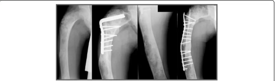 Fig. 2 The second patient who needed revision surgery (ID 12) was a male with a fracture through a fibrous dysplasia lesion of the proximal femur whowas treated with a correction osteotomy and fixation with an angled blade plate in combination with a allog
