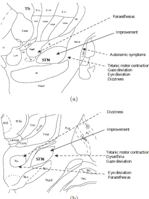 Figure 1. Sites of stimulation-induced effects in the STN region.(a) Sagittal  view. (b) Coronal view