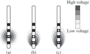 Figure 2 Positioning of the electrode at STN (coronal view) (Medtronic DBS  lead model 3389)