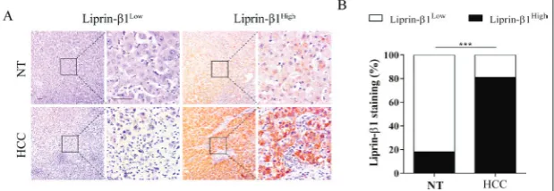 Fig. 1. Expression of liprin-β1 was upregulated in HCC. A – Expression of liprin-β1 in HCC tissues and NT tissues was determined by IHC