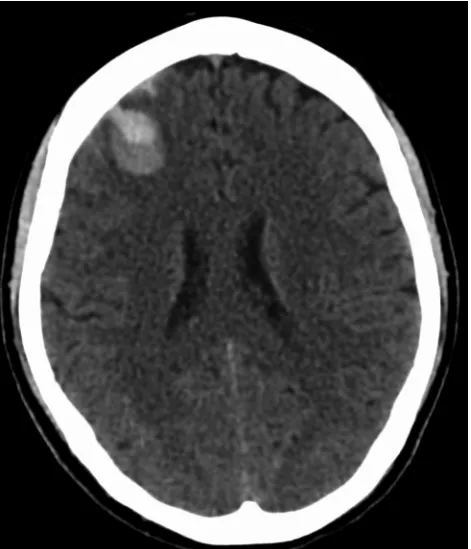 Figure 1 – Initial CT scan showing an acute hematoma in the right frontal lobe and small amount of blood in the adjacent subarachnoid space