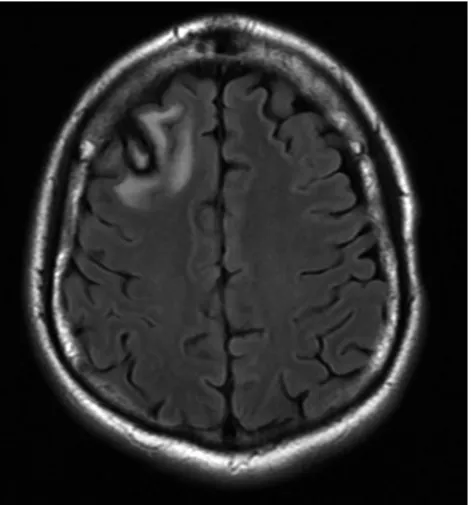 Figure 3 – Follow-up MRI scan (2 months).  Axial T2-FLAIR images with complete reversal of the subcortical white matter changes and reabsorption of the lobar hematoma