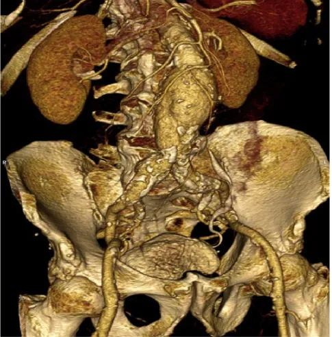 Figure 1 - Three dimensional computed tomographic angiography (3D-CTA) reconstruction of an AAA