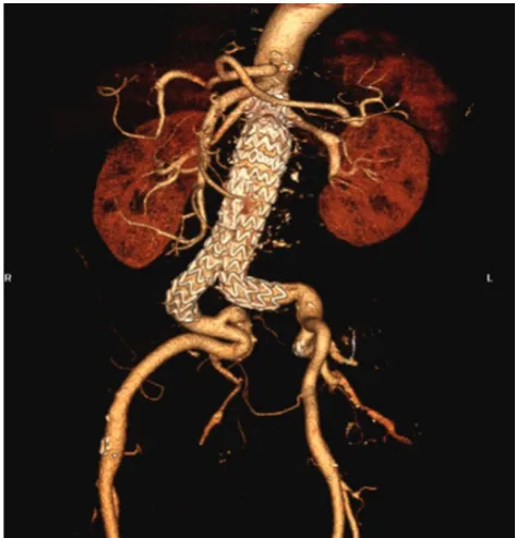 Figure 3 - Dressing in access site, post-EVAR