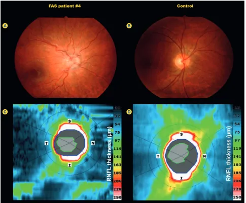 Figure 1 - Representative optic disc fundus photography (A and B) and OCT peripapillary RNFL thickness map (C and D) of a FAS patient (#4) and a control subject