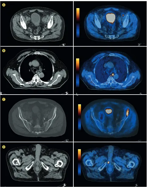 Figure 2 - 18F-FCH PET/CT imaging regarding the same patient as in Fig. 1, showing the presence of lymphadenopathies with abnormally increased prostatic 18F-FCH uptake, suggesting the presence of local-regional (A) and distant (B) lymph node metastatic spreading as well as bone involvement (C), in addition to the involvement of the right corpus cavernosum (D).