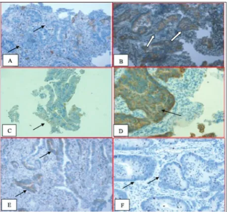 Fig. 2. Representative images for immunohistochemically estimat-ed VEGF, EGFR, Bcl-2 and Ki-67 expression