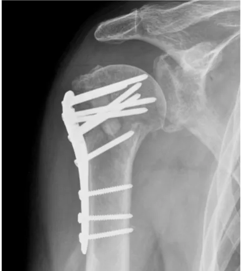 Figure 1 - Fracture treated with bone graft