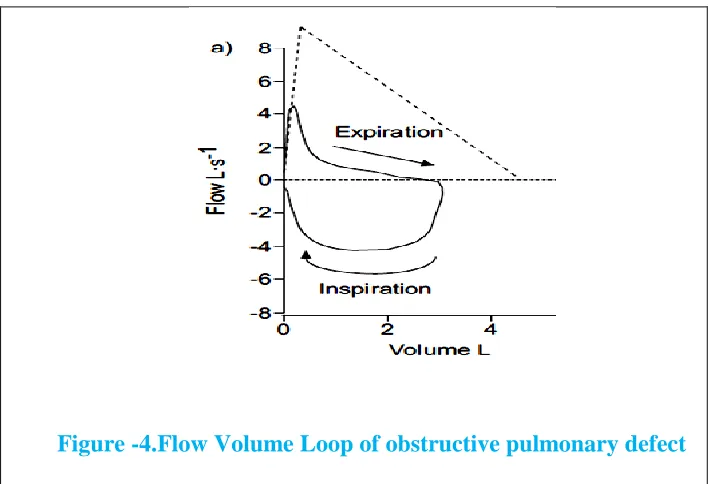 Figure -4.Flow Volume Loop of obstructive pulmonary defect 