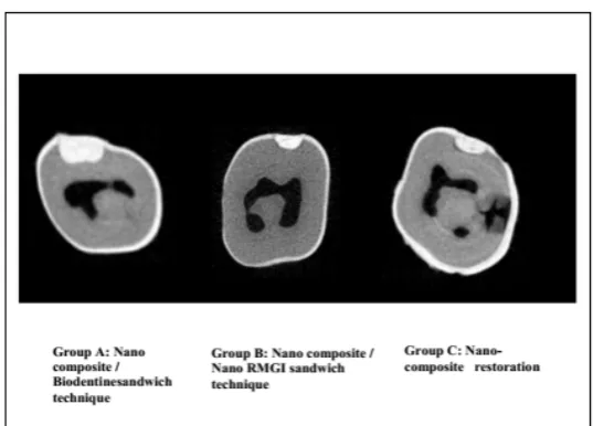 Figure 3:Micro-CT 3D reconstruction images of the three restorative groups teeth showing: very little internal gap in group A, an internal gap in group B, a more internal gap in group C