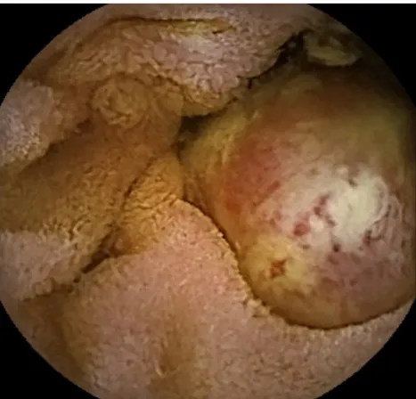 Figure 2 – Small bowel tumor