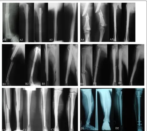 Figure 5 Typical cases undergoing rotary self-locking or interlocking intramedullary nail treatment