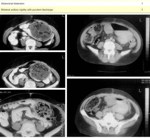 Figure 1 – Pathognomonic well demarcated characteristic mass including entrapped gaseous areas in the core and calcified cavity walls are almost a rule on computed tomography images in our series