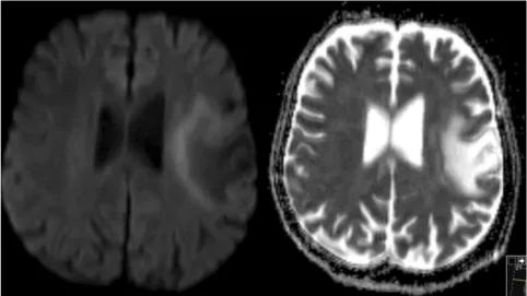 Figure 1 - Brain MRI in the axial plane depicting a hyperintense right frontoparietal lesion on both T2-turbo-spin-echo (left) and T2 Fluid Attenuated Inversion Recovery (FLAIR) (center) involving the subcortical u-fibers and sparing the cortex with no sig