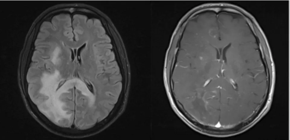 Figure 3 - Axial brain MRI showing a T2 FLAIR hyperintense right fronto-parietal lesion (left) extending to the contralateral side through the splenium of the corpus callosum with mass effect and patchy enhancement on post-contrast T1-weighted images (right), in a patient diagnosed with CNS-Immune Reconstitution Syndrome (IRIS).