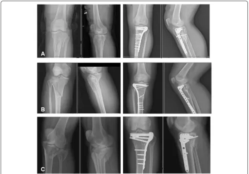 Figure 2 Illustrative cases of group I, treated with unilateral locking plate (ULP). (A)female sustained right knee Schatzker type VI TPF after being in a motor vehicle accident