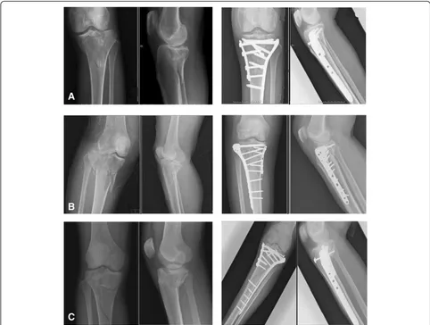Figure 4 Illustrative cases of group III, treated with hybrid dual plates (HDP). (A) A 76-year-old man suffered from left knee TPF, Schatzkerclassification type VI, after a slithering accident, and he subsequently received ORIF with HDP