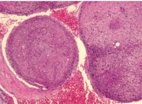 Figure 2 - Toluidine blue staining. Semi-thin section showing rare small-diameter myelinated axons (arrow).