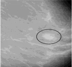 Fig. 1. Breast mass in mammography. 