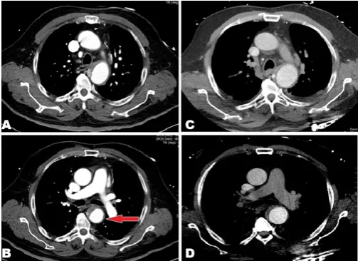 Figure 4: Computed tomography scan images 24 hours later the intramural hematoma has reduced significantly from day-1 (A, B) compared to day-2 (C, D).