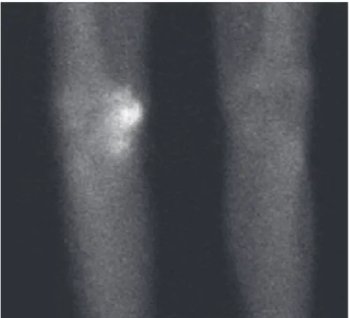 Figure 1: Plain radiograph of right knee demonstrating heterotopic ossification two months after traumatic brain injury.