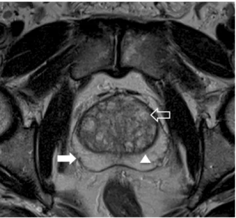 Figure 1 - Axial T2WI depicts the normal zonal anatomy. The pe-ripheral zone appear hyperintense and homogeneous (arrow), clearly separated from the central gland by a pseudocapsule (ar-rowhead)