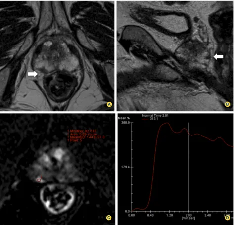 Figure 2 - Images in a 76-year-old man with persistent high PSA level of 11 ng/mL and an initial negative biopsy