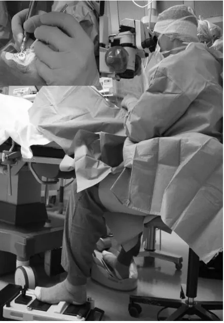 Figure 1. Surgeon’s position during modern cataract sur- gery is shown with one instrument in each hand, manipu- lating the intraocular tissues through incisions < 1 mm - 2.5 mm (inset top left)