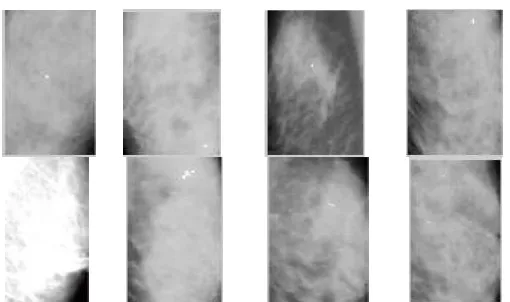 Fig. 7:  ROIs containing microcalcifications. Total eight ROIs were selected, and every ROI included a number of micro-calcifications with varied shape, size and distribution