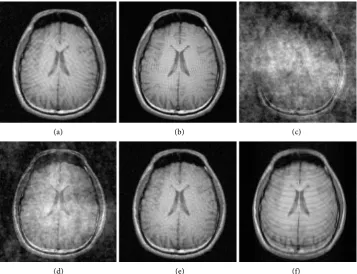Figure 2. CS reconstructions of T1 MRI with 25% samples. (a) Radial; (b) Spiral; (c) Random; (d) 2D variable density; (e) 2D variable density with 25 point fully sampled center radius; (f) 1D variable density with 32 line fully sampled center