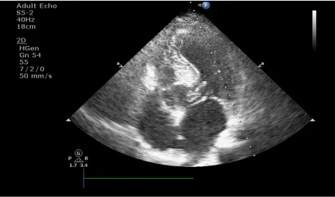 Figure 1 - Transthoracic echocardiographic image of accessory mitral valve