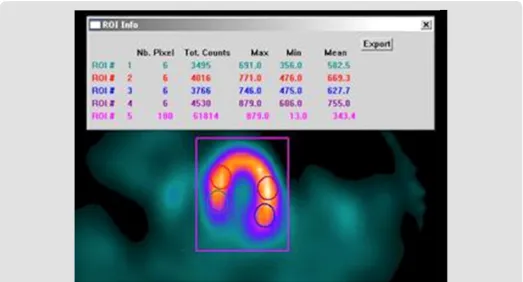 Figure 1: The Breast Enhanced Scintigraphy Test (BEST) Imaging component of FMTVDM allows MBI to be calibrated, enhanced and quantified differentiating calcium from normal breast tissue from inflammatory breast changes from pre-cancers and breast cancer; p