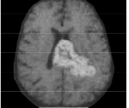 Fig. 1 Brain image with a tumor. 