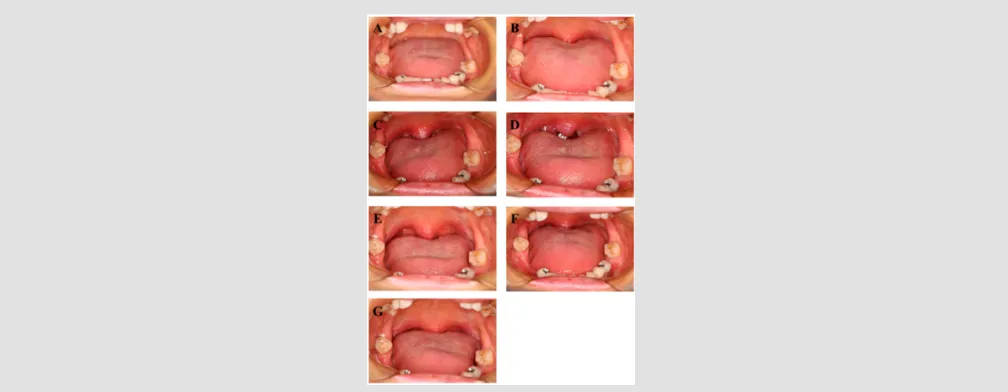 Figure 2: Typical clinical case treated by the Er:YAG laser. A, intraoral view of Pre
