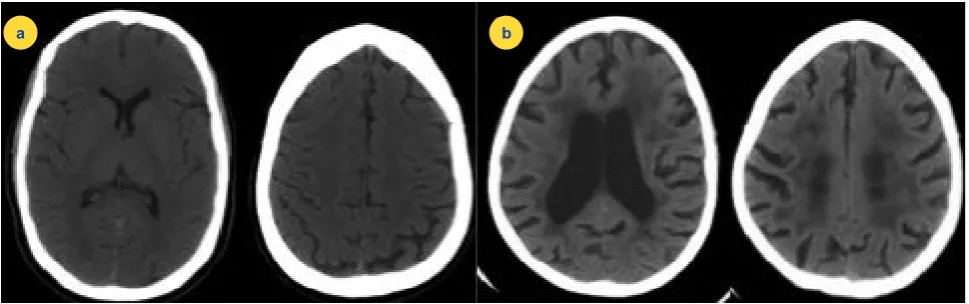 Figure 1 – ARWMC grading scale. a) – Axial CT scan slices: the absence of white matter abnormalities may be observed, ARWMC rating score 0