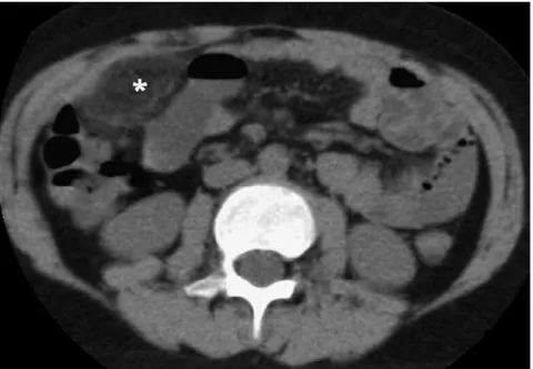 Figure 1 - Computerized tomography scan demonstrating a cake-like, high attenuation, fatty mass (asterisk) confirming the diagnosis of omental infarction