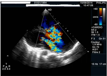Figure 3. Ventricular septal defect in trans thoracic echography. 