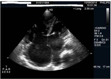Figure 5. Trans-thoracic echography, shows an ostium primum atrial septal defect, 2 atrio-  ventricular valves, a bi-auricular dilatation and right ventricular dilatation