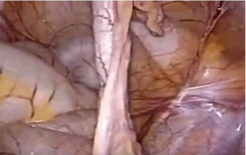 Figure 2: A graph showing the spinal needle anchoring the seromuscular layer of the appendix.
