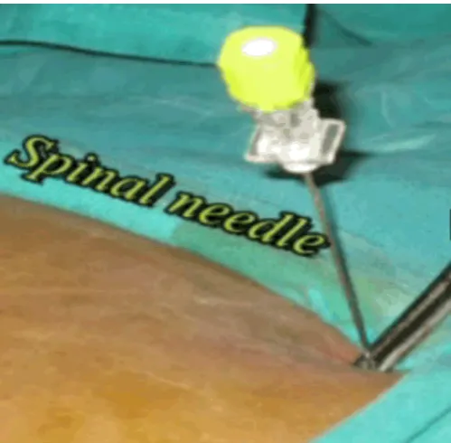 Figure 3: The spinal needle fixed on the abdominal wall by an artery forceps.