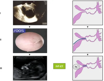 Figure 1 - Hydrosalpinx before (I) and upon (II-III) placement of an Essure® micro-insert device