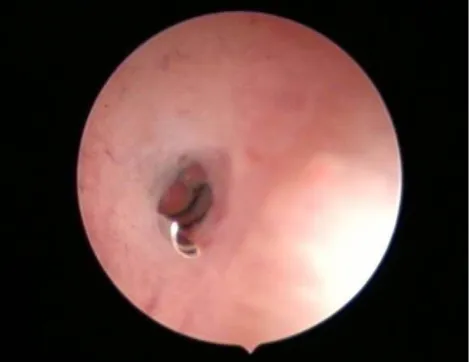 Figure 2 - Number of spirals visible in the uterine cavity upon placement of an Essure® device at the tubal ostium of the affected fallopian tube