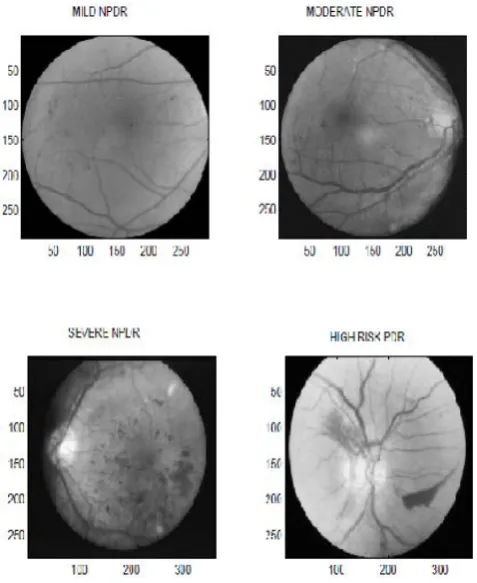 FIGURE 2: Different stages of Diabetic Retinopathy 