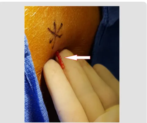 Figure 6: An illustration showing a portion of the biopsy specimen that is trapped in the skin and subcutaneous tissue (short arrow) and a portion of the biopsy that remains on the surface of the skin once the needle has been completely withdrawn (long Arrow).
